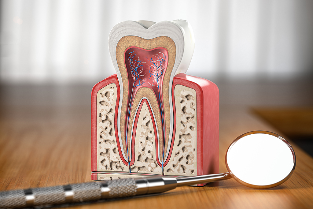 重度のむし歯には根管治療