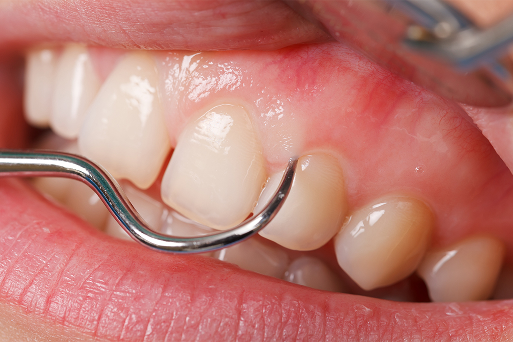 日本人がもっとも歯を失う原因を排除する～歯周病治療～